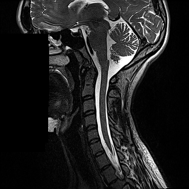 Kaularangan T2-sagittaalinen anatomia